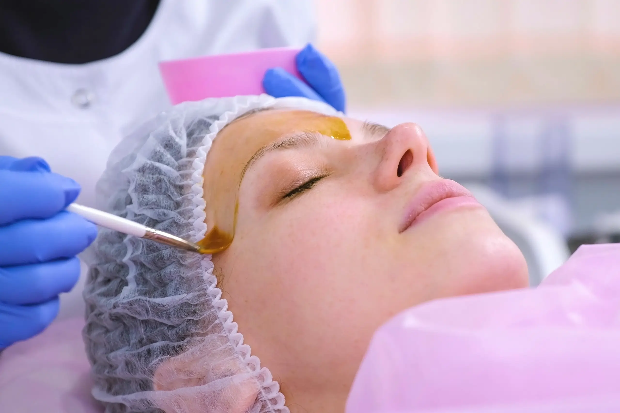 Chemical Peels in The Woodlands, TX