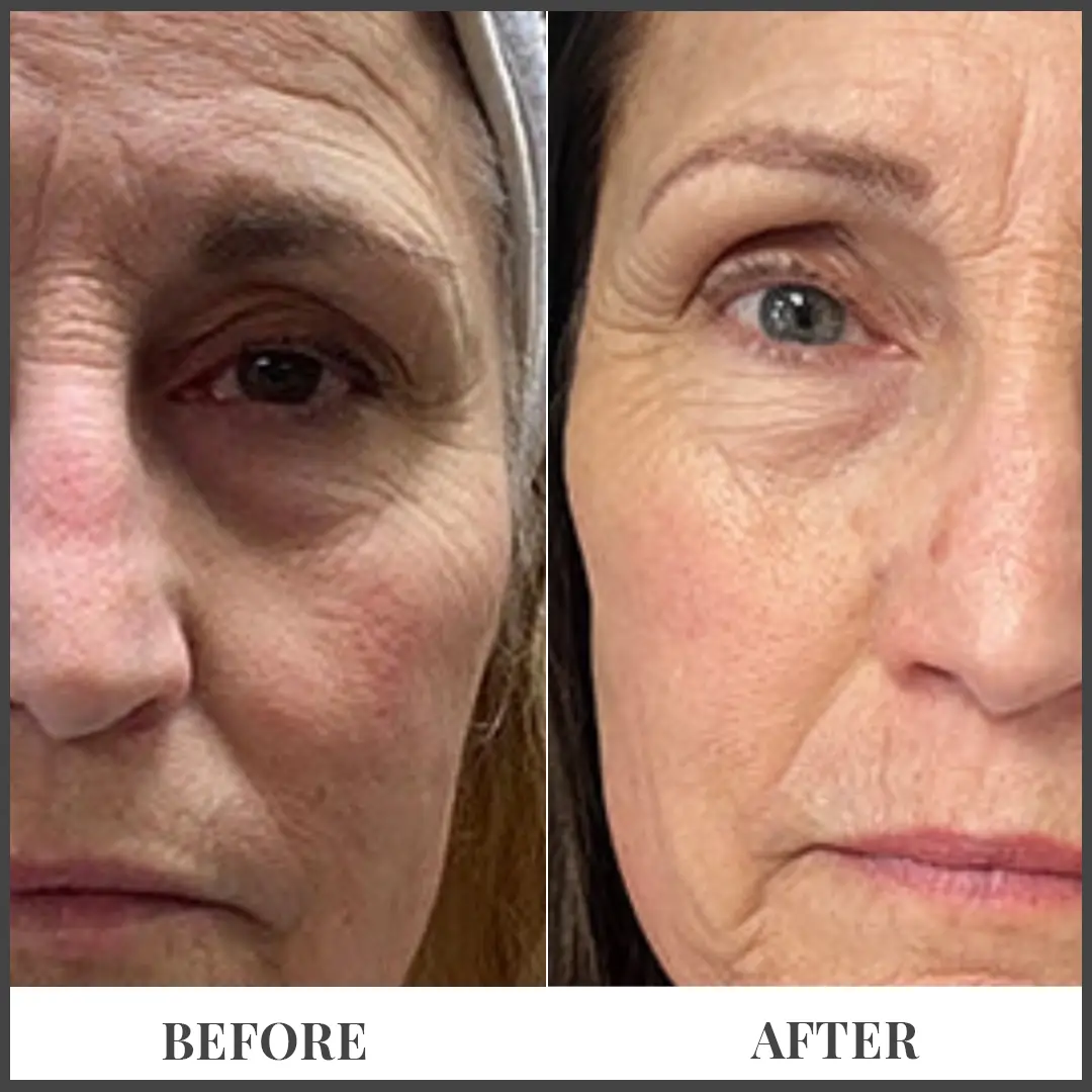Before and After Treatment in The Woodlands, TX | Naked SKN in The Woodlands, TX