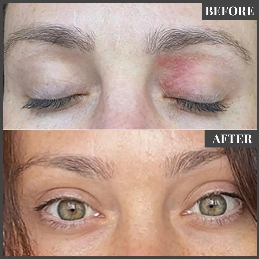 Before and After Treatment in The Woodlands, TX | Naked SKN in The Woodlands, TX