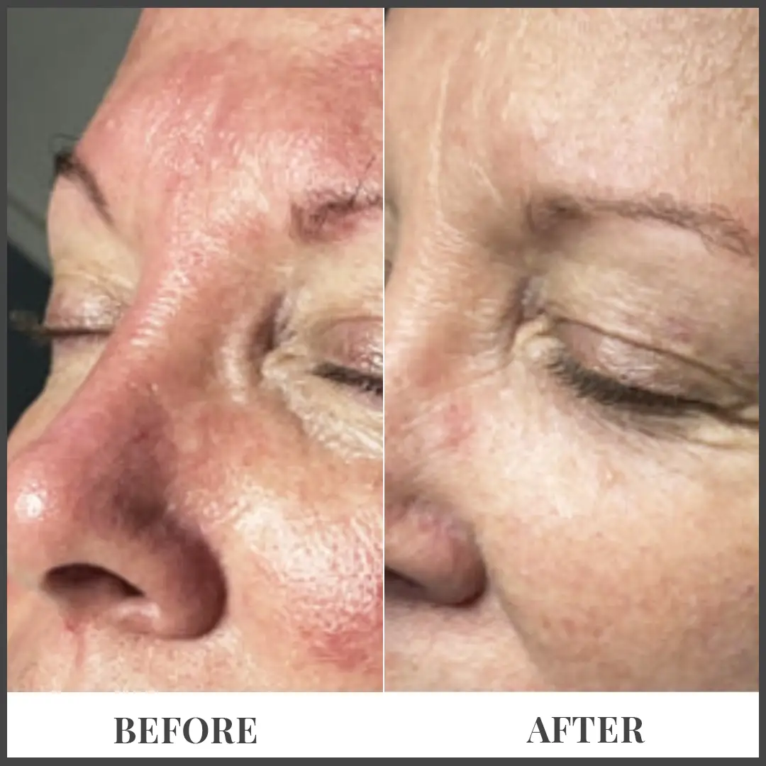 Before and After Treatment in The Woodlands, TX | Naked SKN in The Woodlands, TX