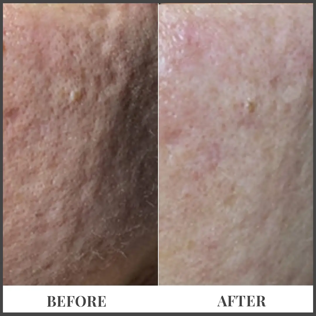Before and After Treatment in The Woodlands, TX | Naked SKN in The Woodlands, TX