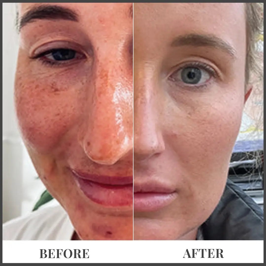 Before and After Treatment in The Woodlands, TX | Naked SKN in The Woodlands, TX