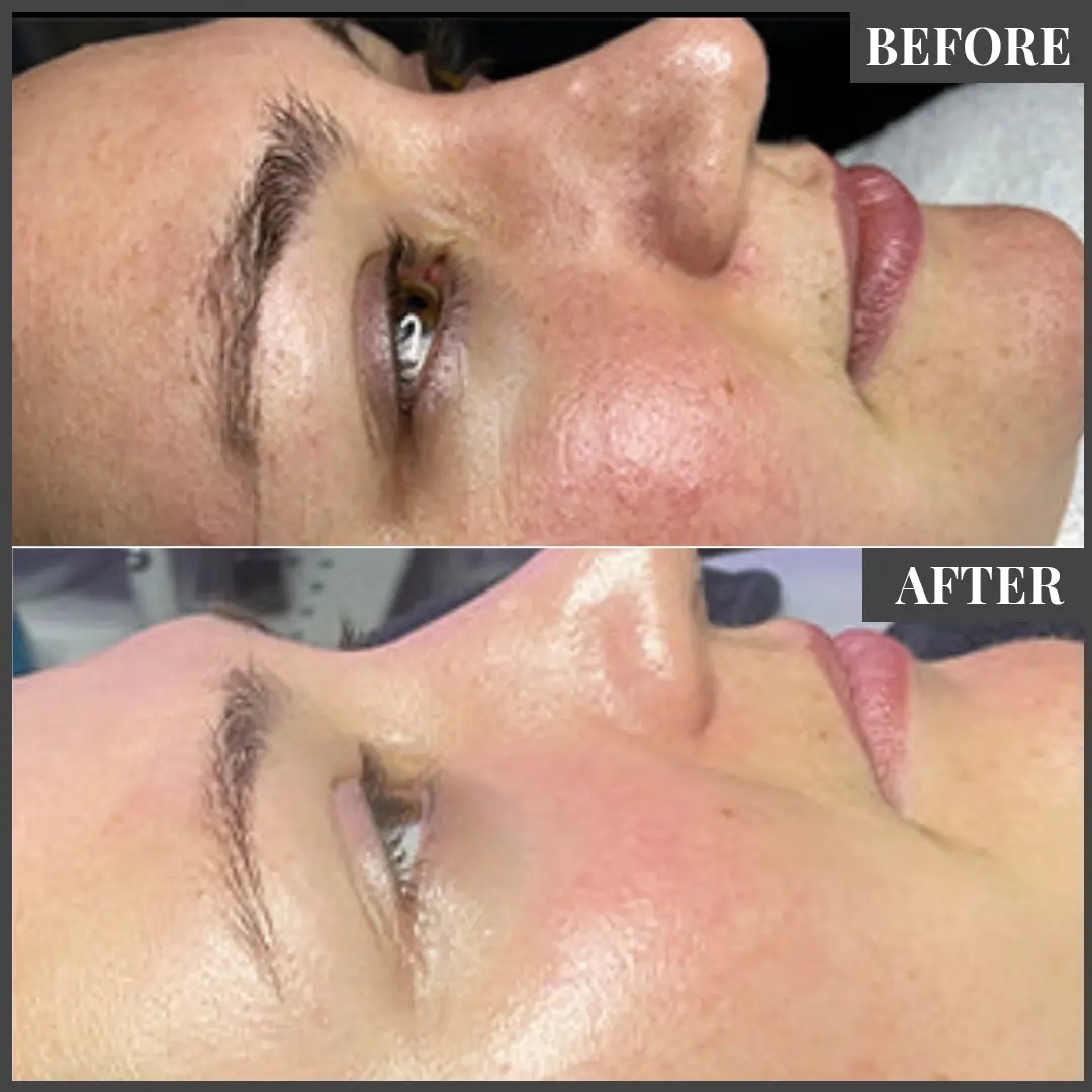 Before and After Treatment in The Woodlands, TX | Naked SKN in The Woodlands, TX