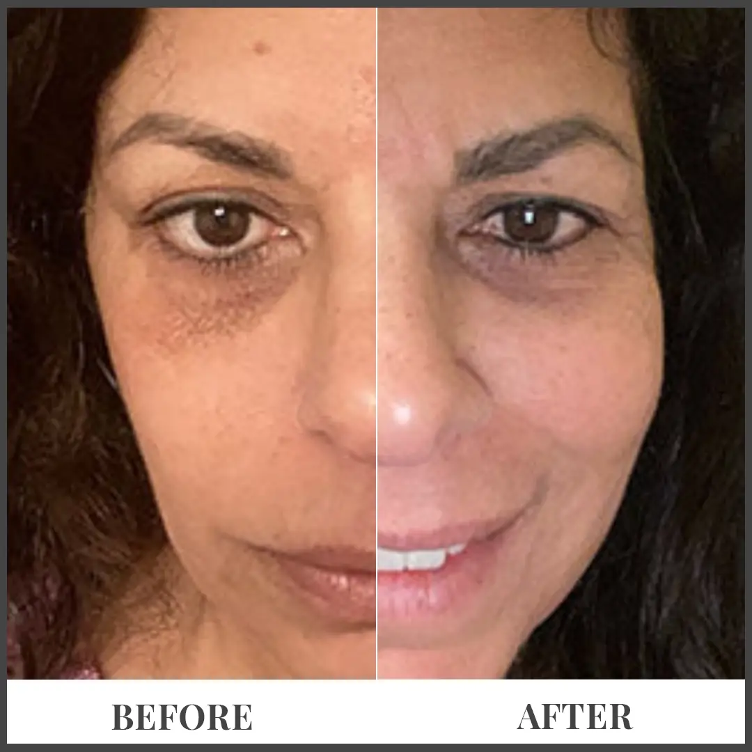 Before and After Treatment in The Woodlands, TX | Naked SKN in The Woodlands, TX