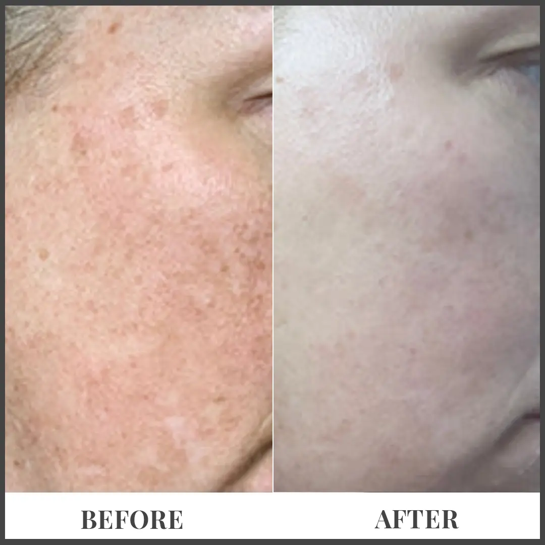 Before and After Treatment in The Woodlands, TX | Naked SKN in The Woodlands, TX