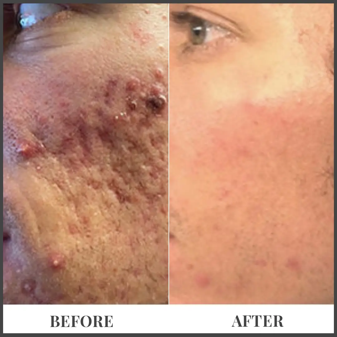 Before and After Treatment in The Woodlands, TX | Naked SKN in The Woodlands, TX