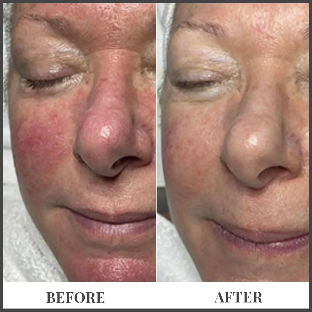 Before and After Treatment in The Woodlands, TX | Naked SKN in The Woodlands, TX