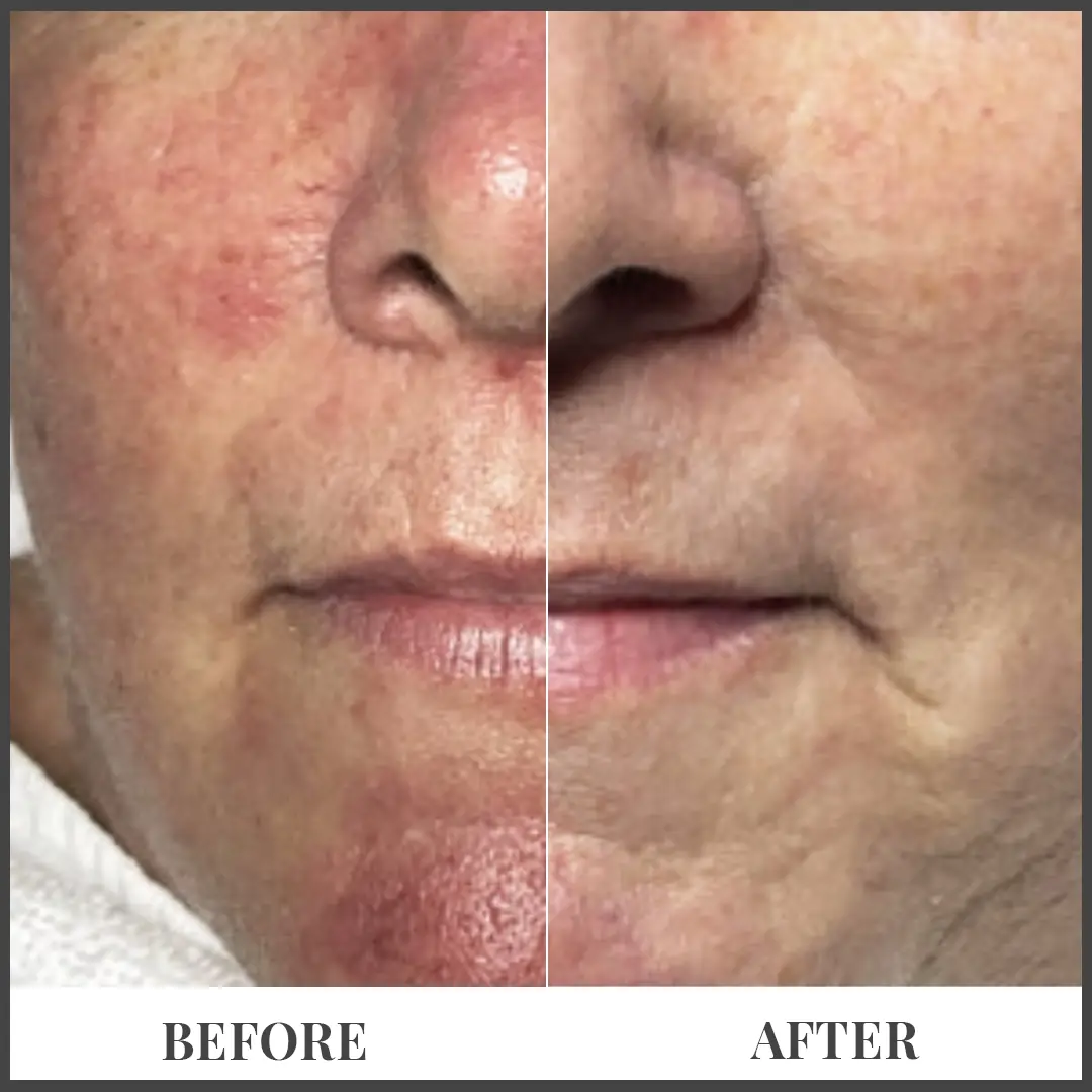 Before and After Treatment in The Woodlands, TX | Naked SKN in The Woodlands, TX