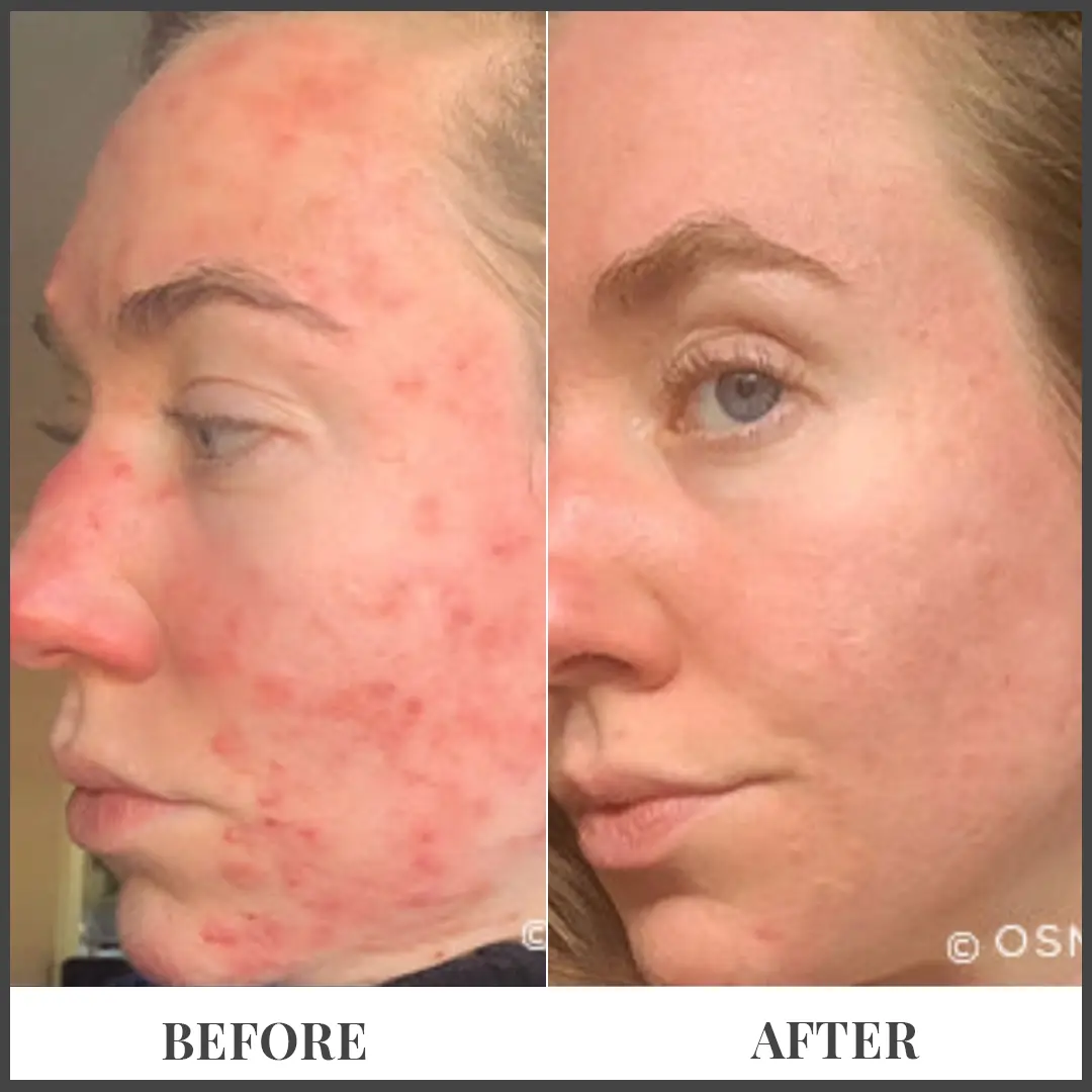 Before and After Treatment in The Woodlands, TX | Naked SKN in The Woodlands, TX