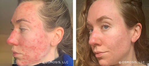 Chemical Peels Treatment