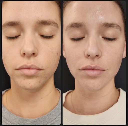 Chemical Peels before and after