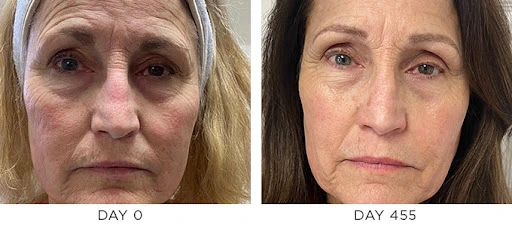 SkinPen® Microneedling before and after