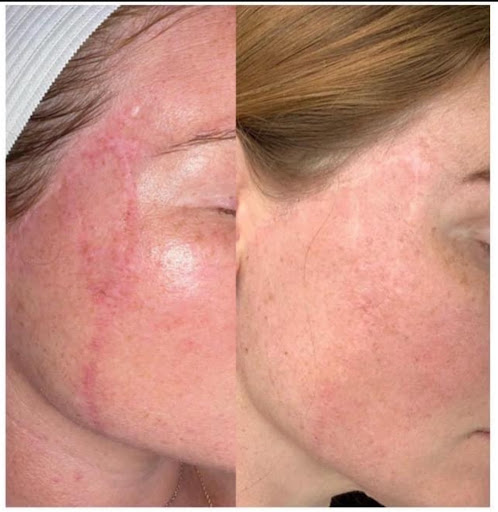 hydrafacial before and after