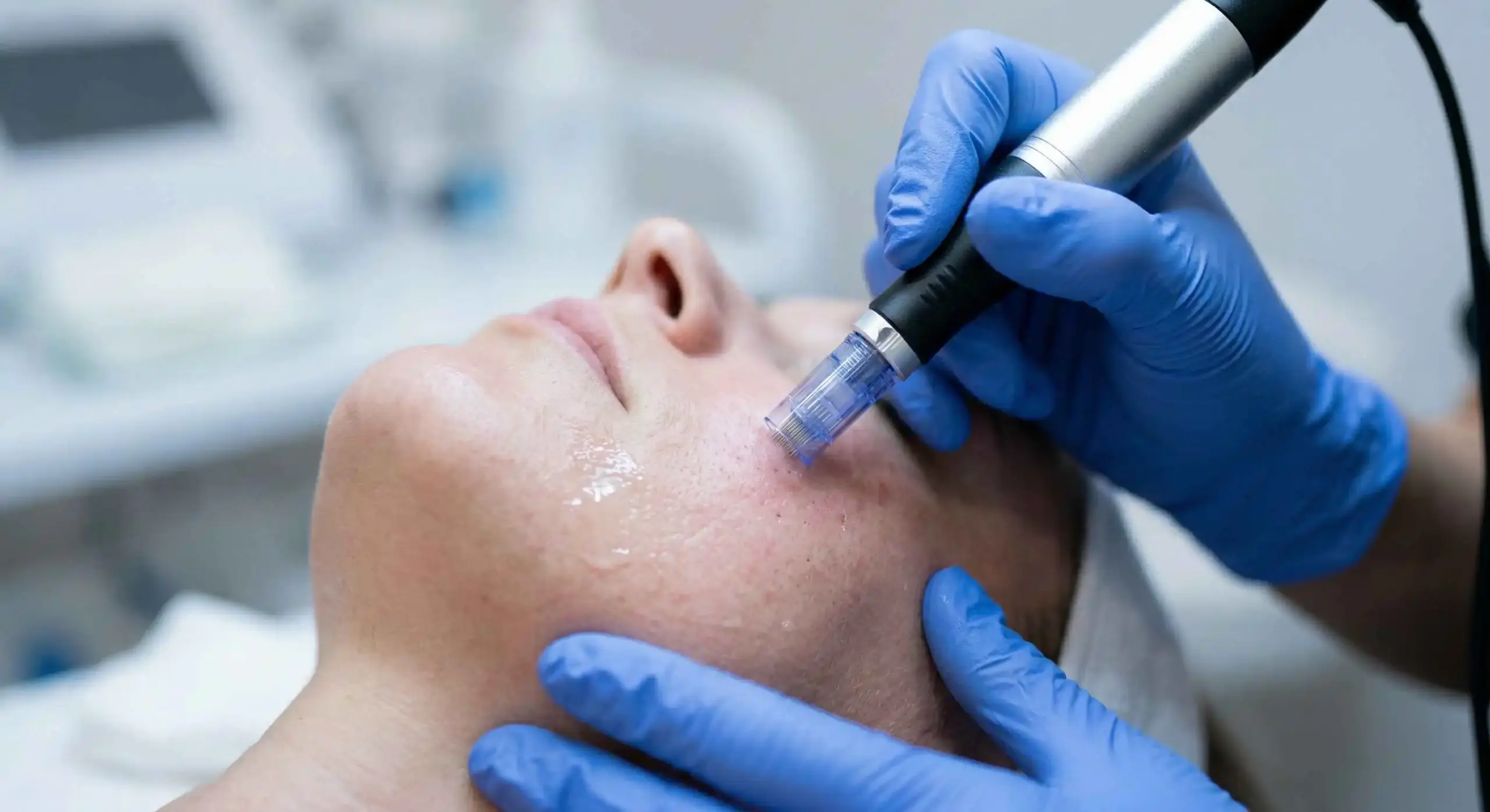 SkinPen Microneedling