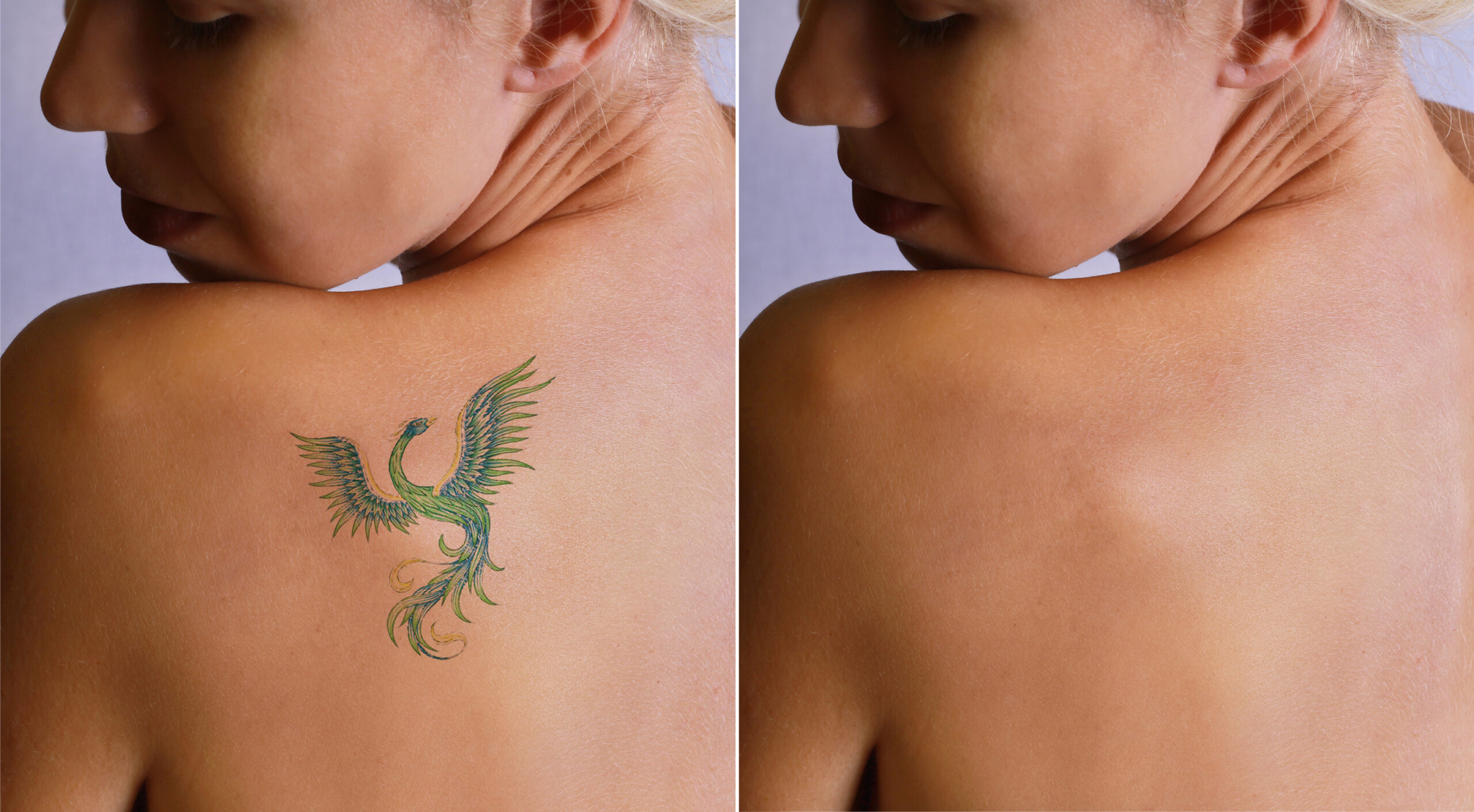 Naked SKN Aesthetics™ iStock-514411126-scaled Tattoo Removal & Scar Remodeling  